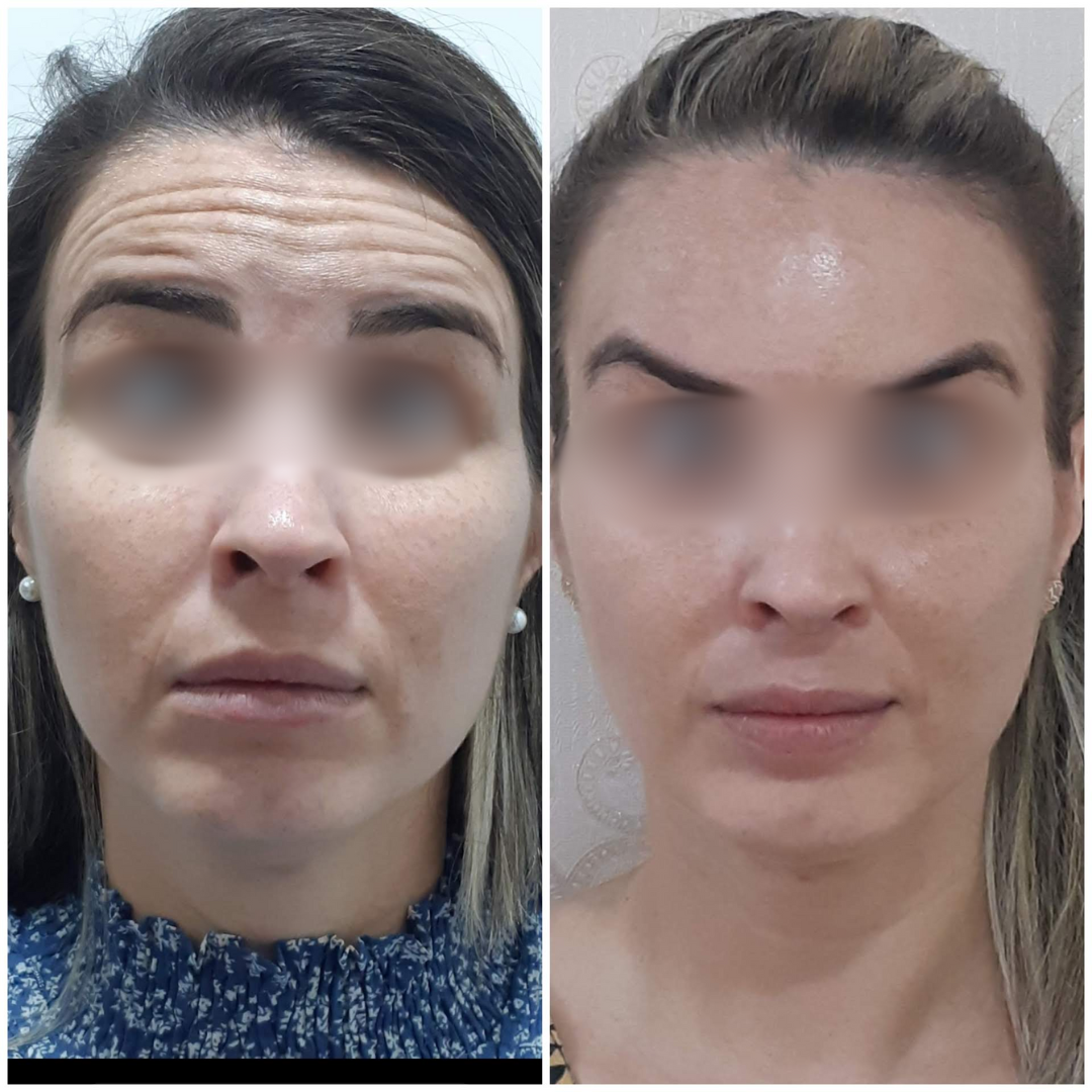 Antes e Depois
