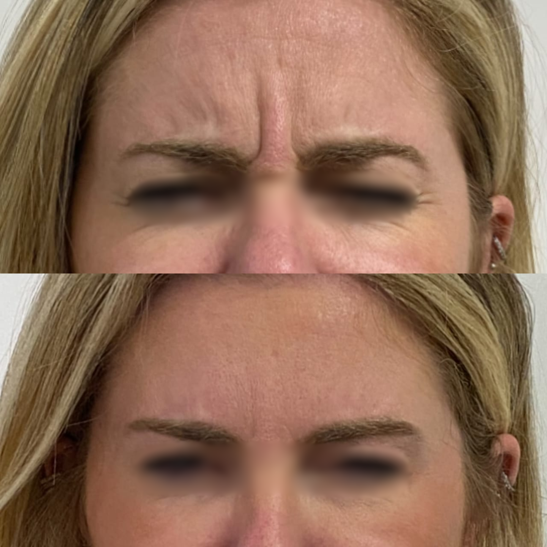 Antes e Depois