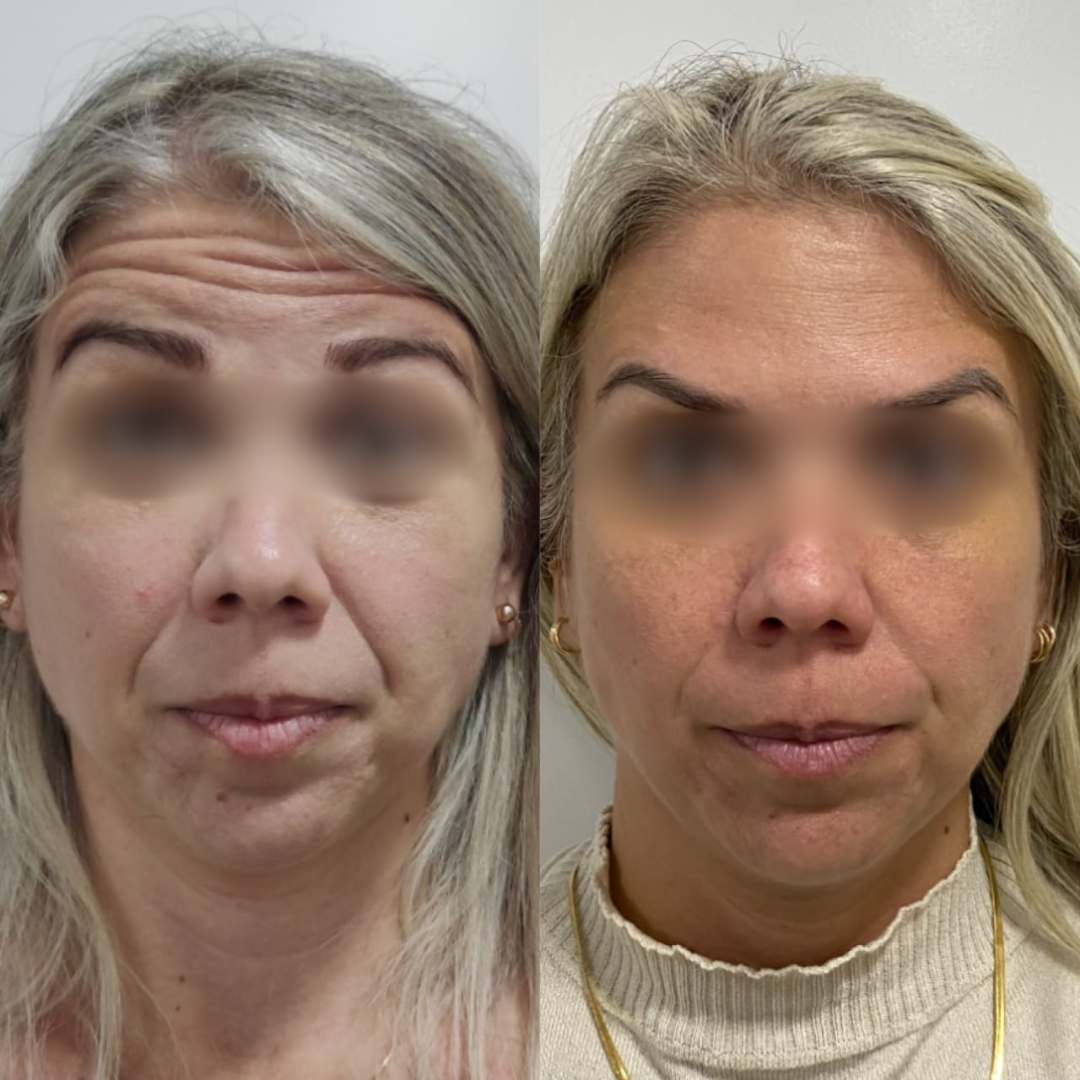 Antes e Depois