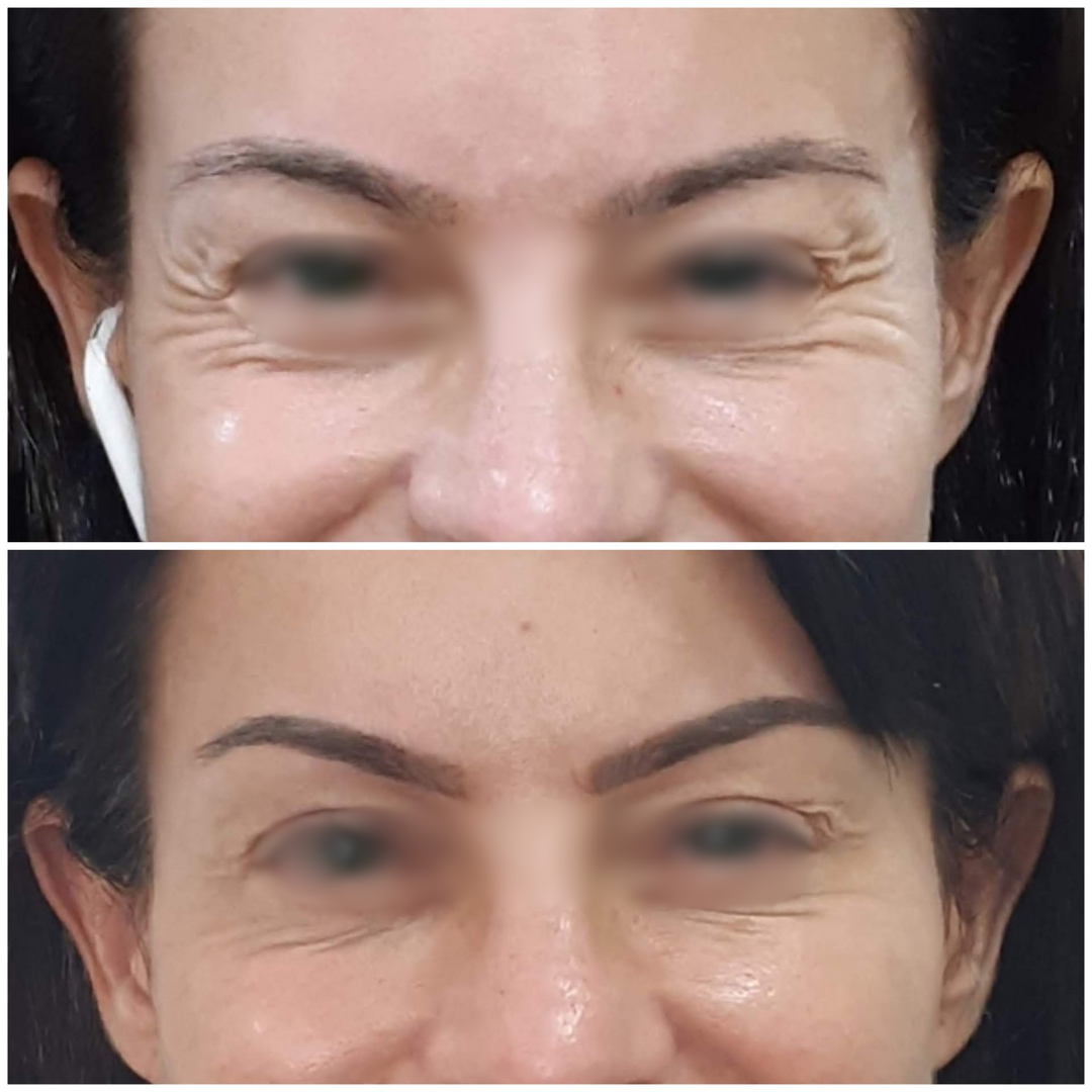 Antes e Depois