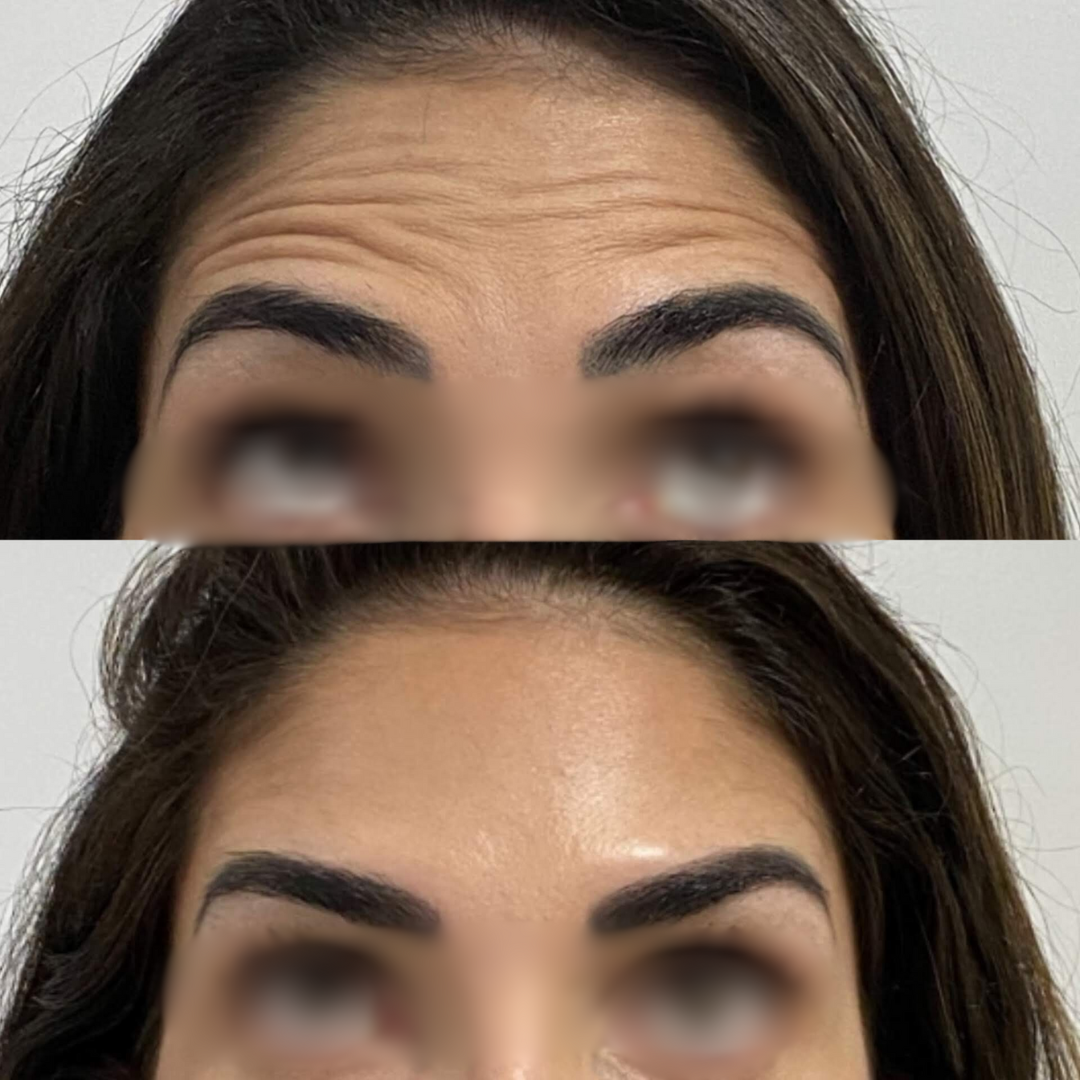 Antes e Depois