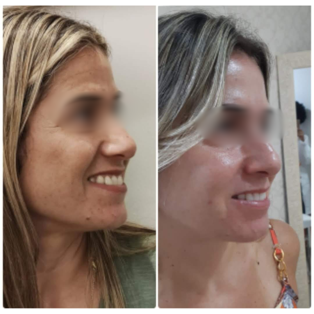 Antes e Depois