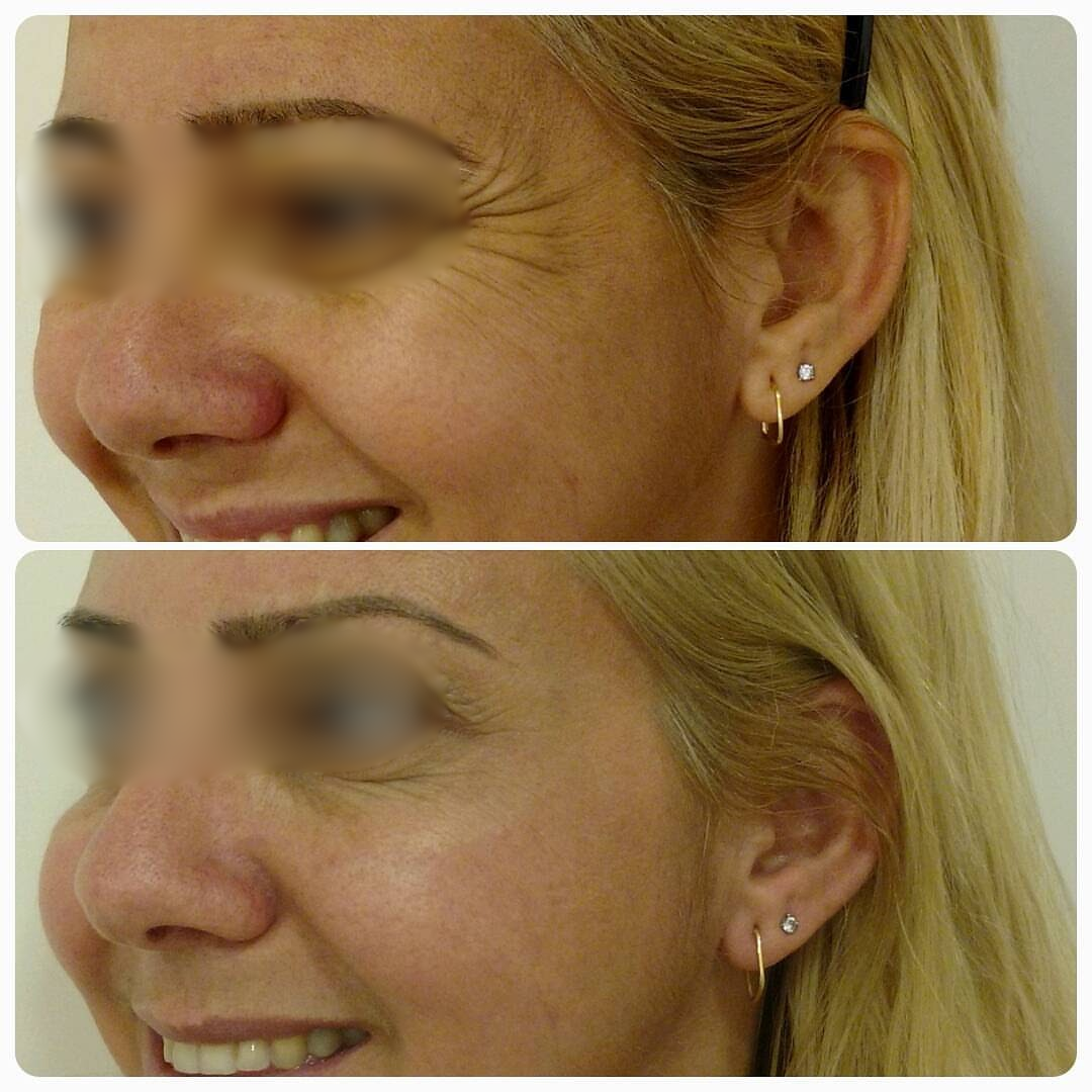 Antes e Depois