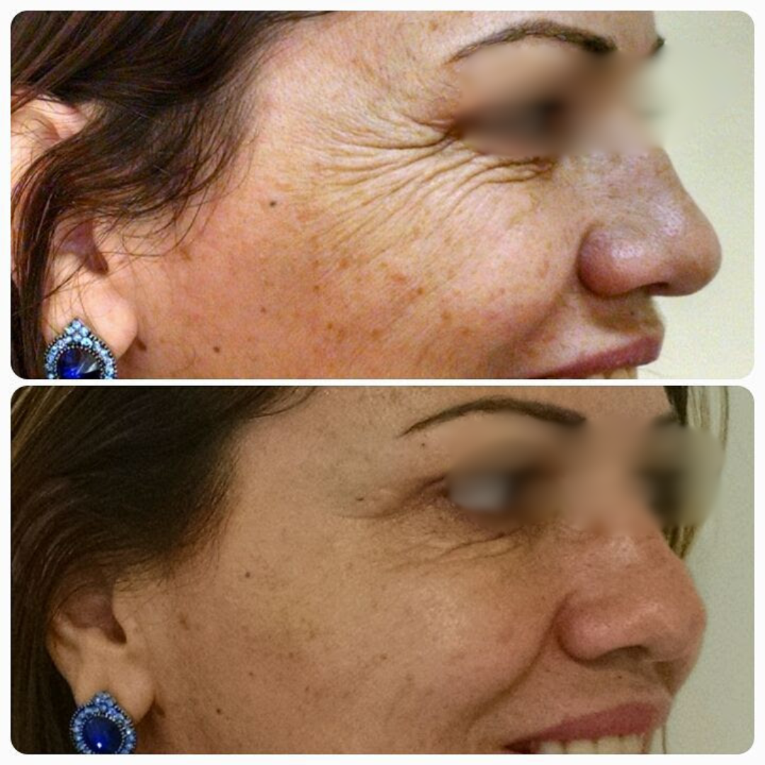 Antes e Depois